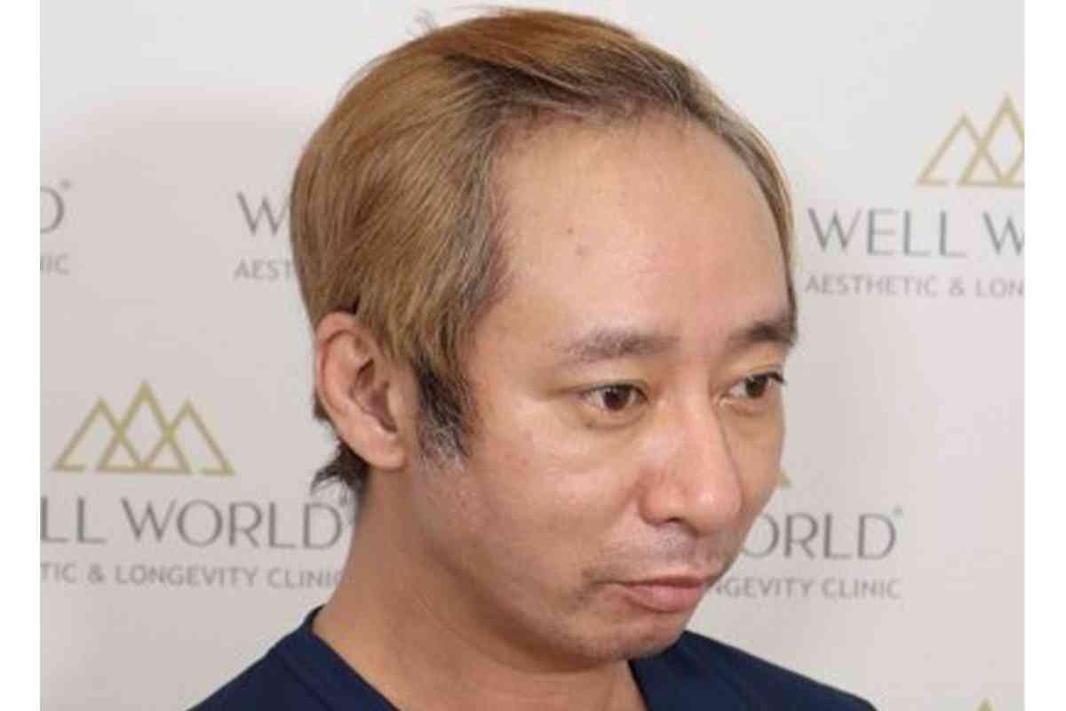 《「ハゲ」「キモい」と言われ…》いしだ壱成　薄毛で芸能界引退、うつ・離婚も…植毛で取り戻した自信「ここからが第二の人生」