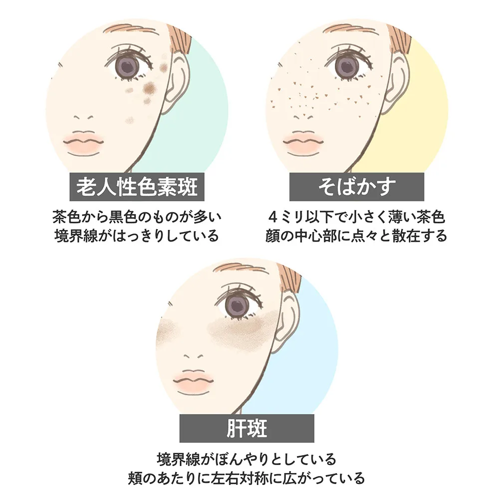 肝斑が酷い😭