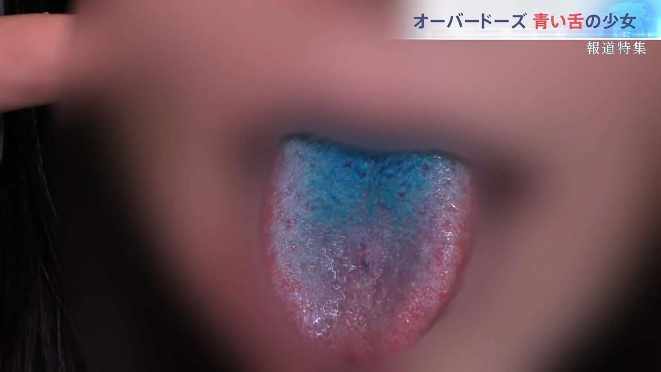 “生きるためにやる”――青い舌の少女たち　高校生の70人に1人が経験、死に至るケースもある「オーバードーズ」彼女たちを救うには