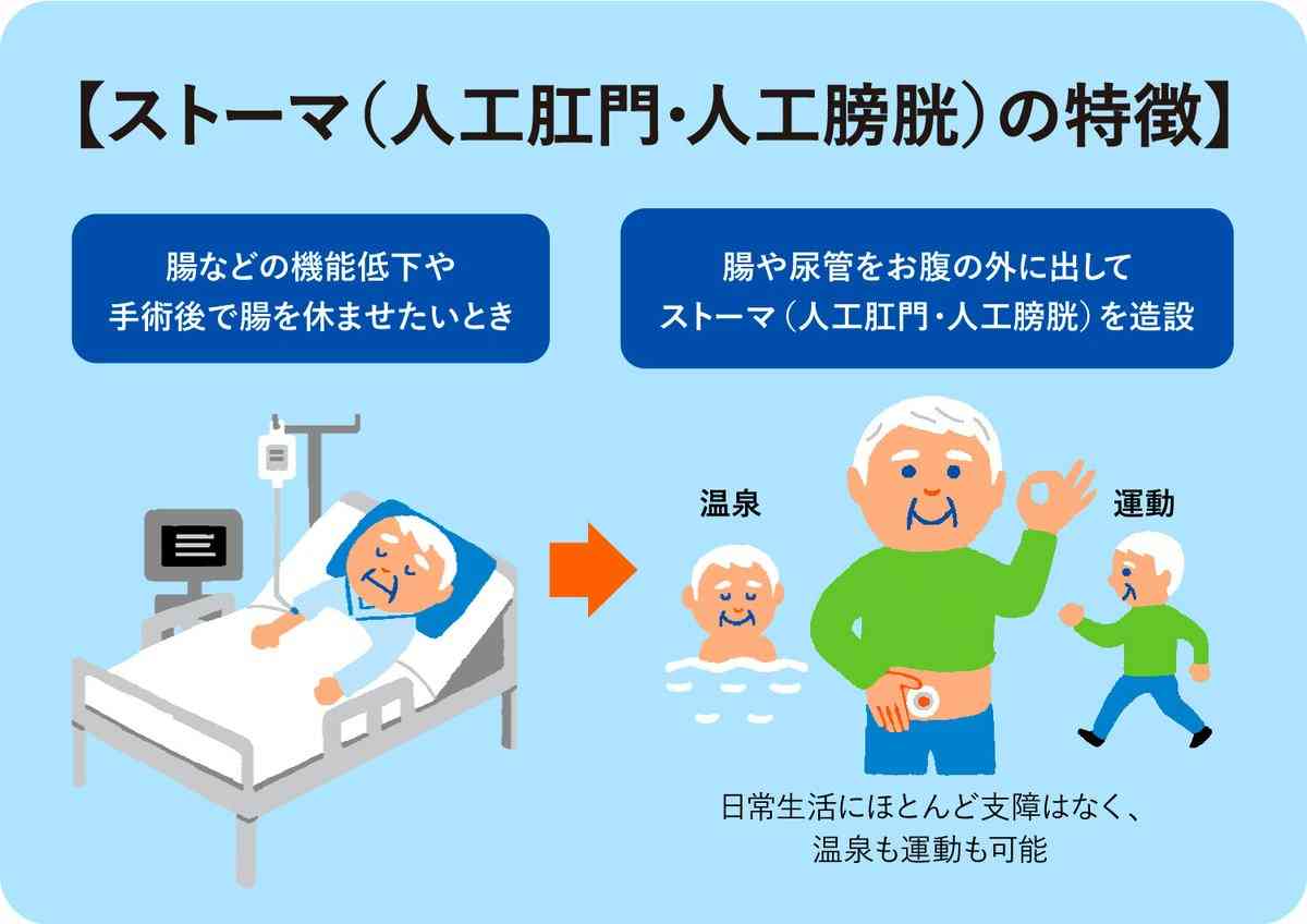 ストーマとは？人工肛門・人工膀胱のケアやトラブル対策、公的支援まで解説 - LIFULL 介護(ライフル介護)