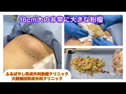 大腿部の非常に大きな粉瘤　ブログでも粉瘤について詳しく解説してます。東京皮膚のできものと粉瘤クリニック　ふるばやし形成外科新宿院　大阪梅田形成外科クリニック