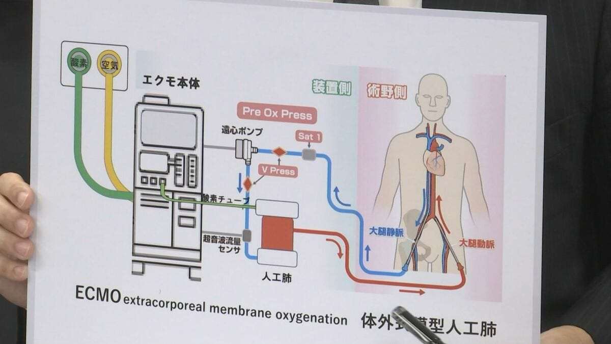 「ECMO(エクモ)」酸素配管の接続ミスで、約20分間、酸素が供給されない状態に…70代男性患者が低酸素脳症で意識不明の重体となる医療事故　警報アラームが複数回鳴るも不具合に気づかず　鳥取県立中央病院